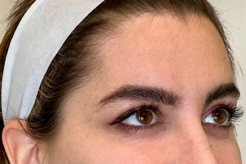 BOTOX Before & After Gallery - Patient 344936 - Image 1