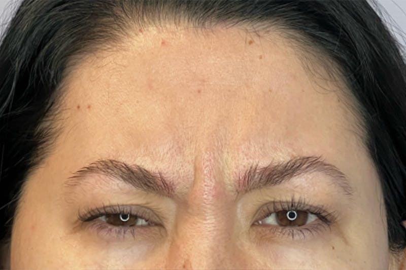 Dysport Before & After Gallery - Patient 209788 - Image 1