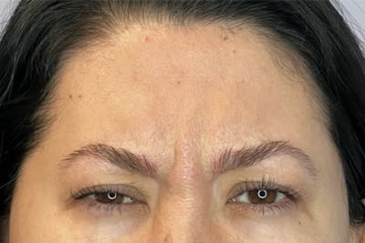 Dysport Before & After Gallery - Patient 209788 - Image 1