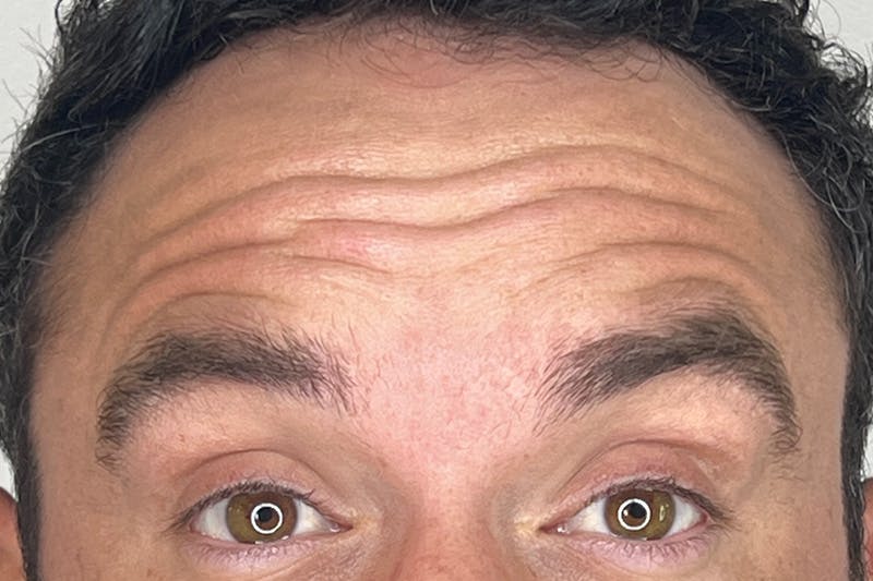 BOTOX Before & After Gallery - Patient 295976 - Image 1