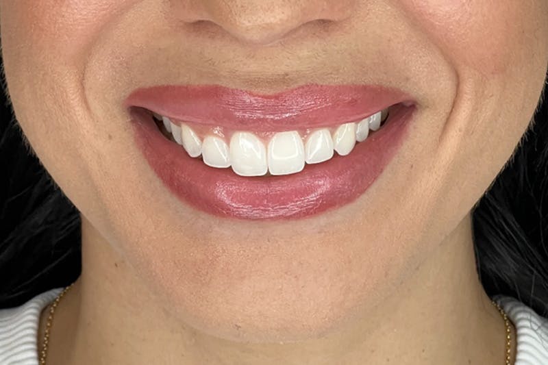 BOTOX Before & After Gallery - Patient 321406 - Image 2