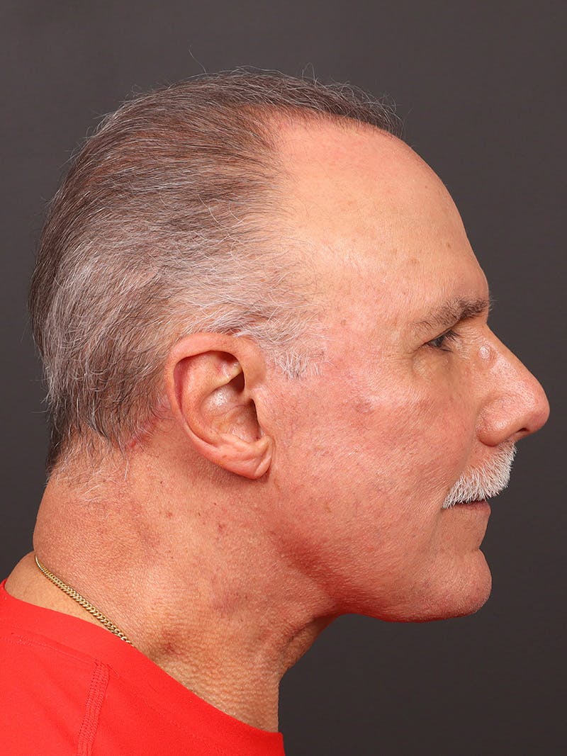 Facelift Before & After Gallery - Patient 557057 - Image 6