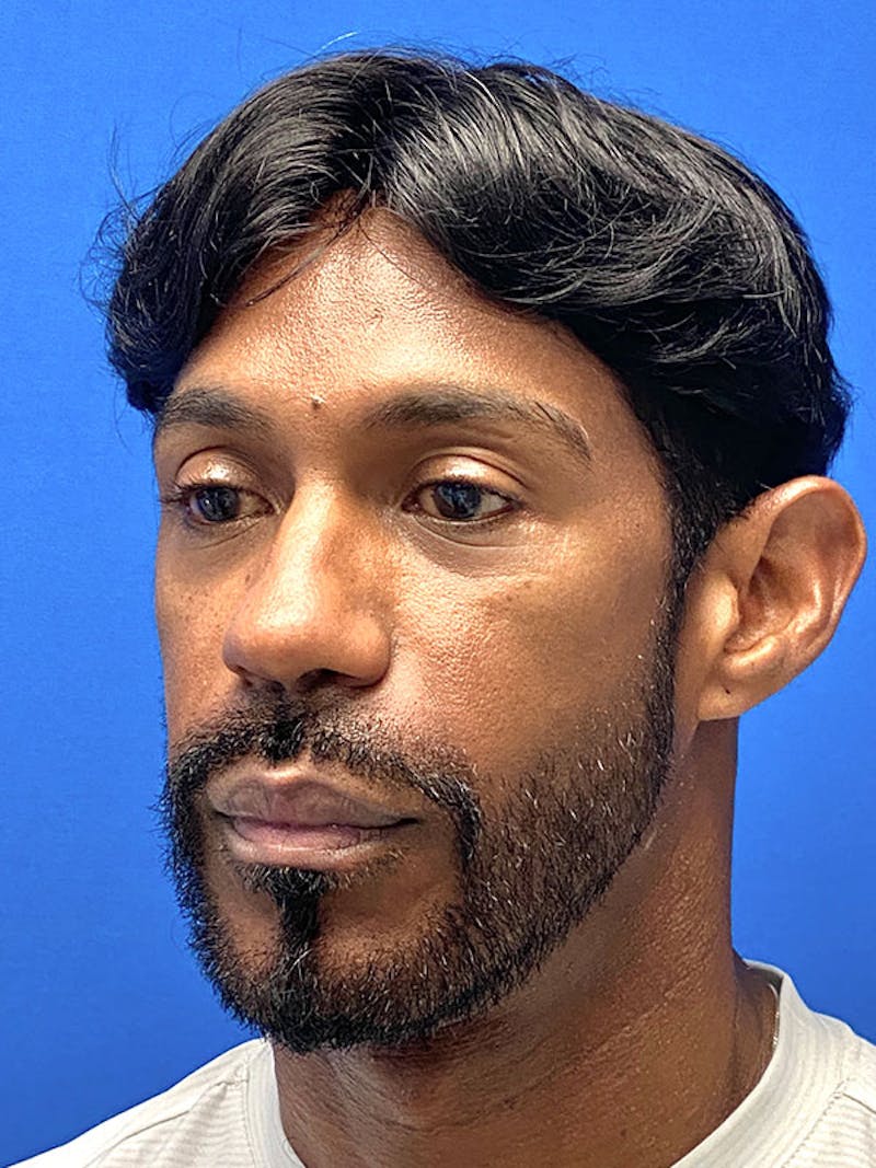 Primary Rhinoplasty Before & After Gallery - Patient 899073 - Image 5