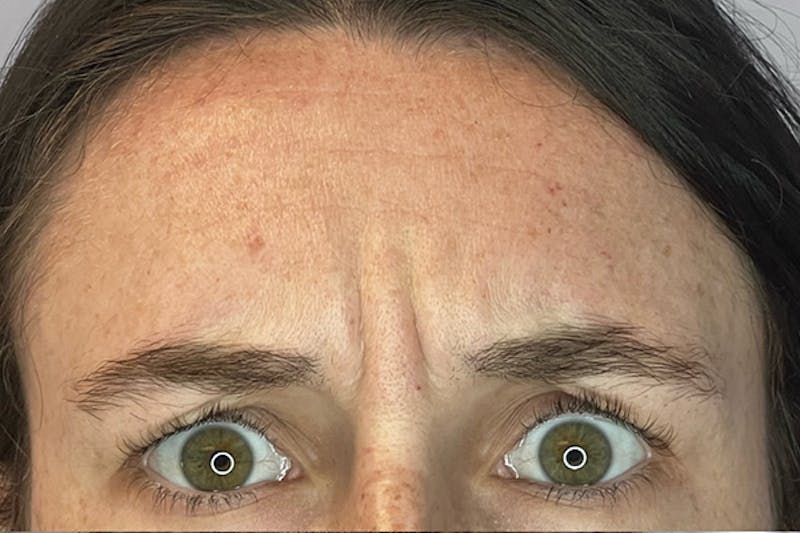 Dysport Before & After Gallery - Patient 182212 - Image 1