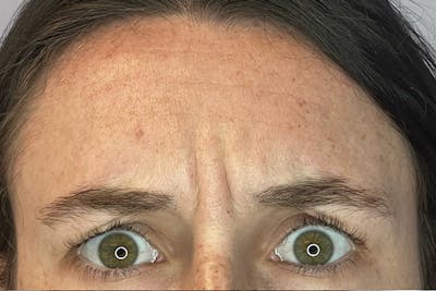 Dysport Before & After Gallery - Patient 182212 - Image 1
