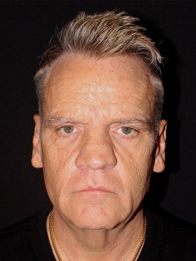Male Face & Neck Before & After Gallery - Patient 916712 - Image 1