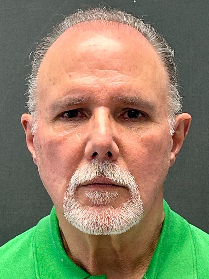 Facelift Before & After Gallery - Patient 557057 - Image 1