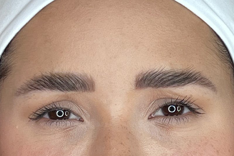 Dysport Before & After Gallery - Patient 116764 - Image 6