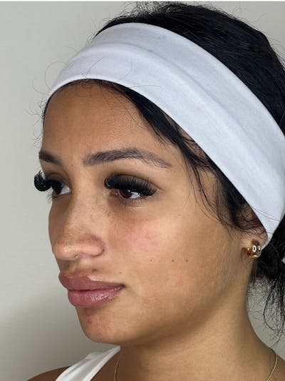 Facial Balancing Before & After Gallery - Patient 122722 - Image 1