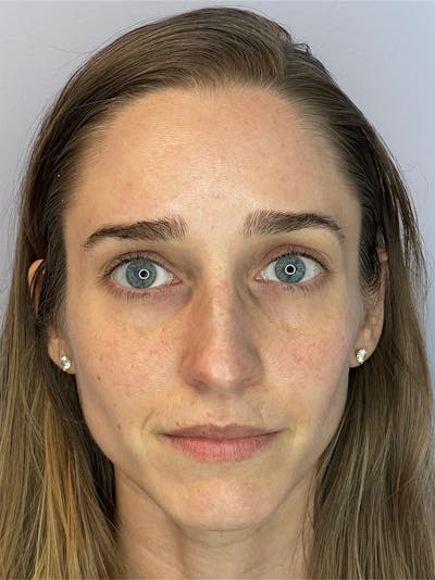 Sculptra Before & After Gallery - Patient 194961 - Image 1