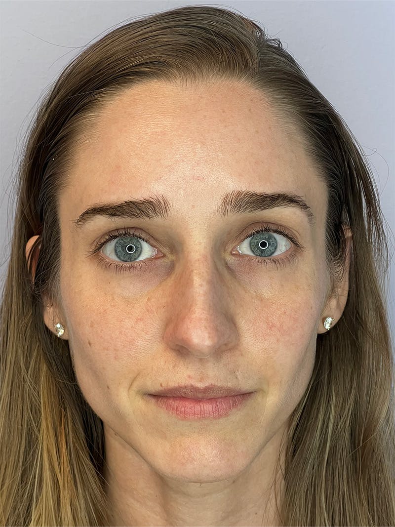 Sculptra Before & After Gallery - Patient 194961 - Image 1