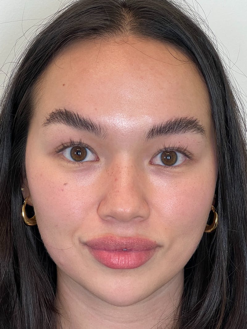 Facial Balancing Before & After Gallery - Patient 608115 - Image 1