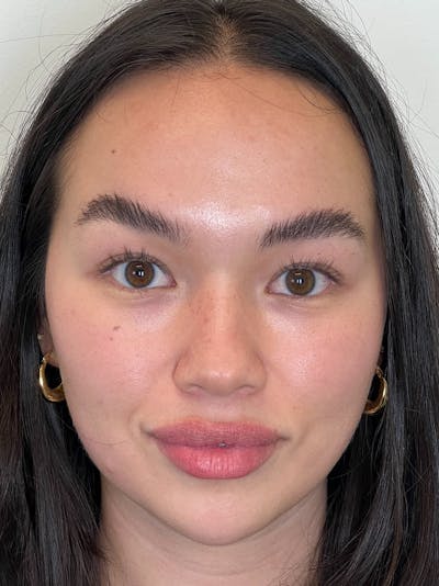 Facial Balancing Before & After Gallery - Patient 608115 - Image 1