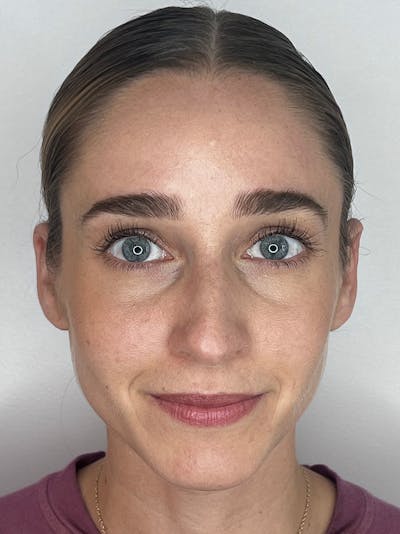 Sculptra Before & After Gallery - Patient 194961 - Image 2