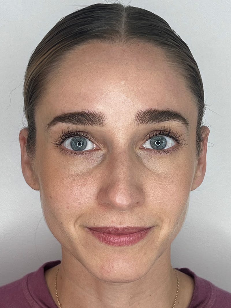 Sculptra Before & After Gallery - Patient 194961 - Image 2