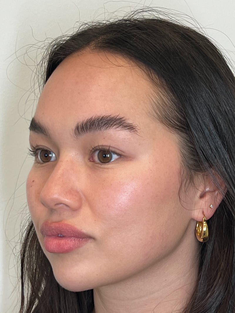 Facial Balancing Before & After Gallery - Patient 608115 - Image 4