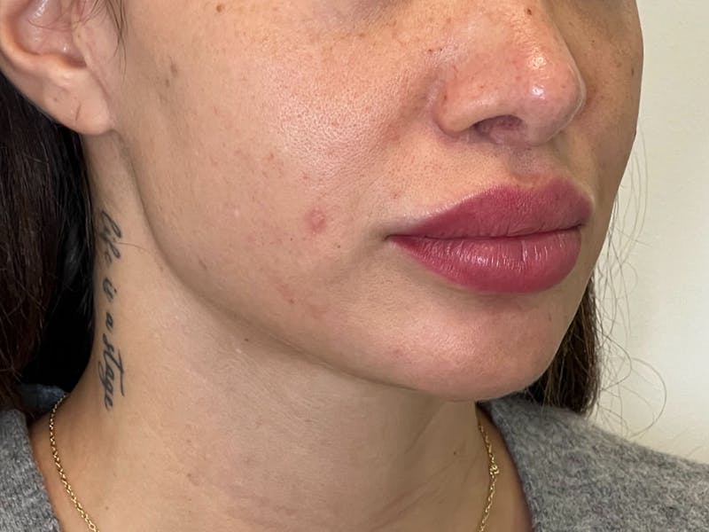 Sculptra Before & After Gallery - Patient 312899 - Image 1