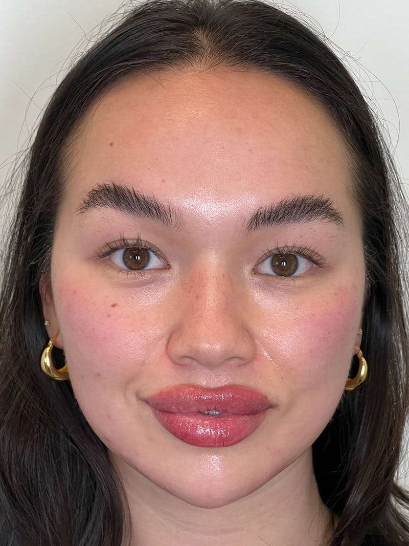 Facial Balancing Before & After Gallery - Patient 608115 - Image 2