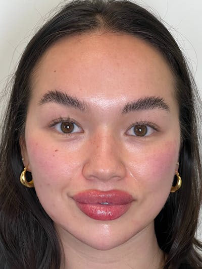 Facial Balancing Before & After Gallery - Patient 608115 - Image 2