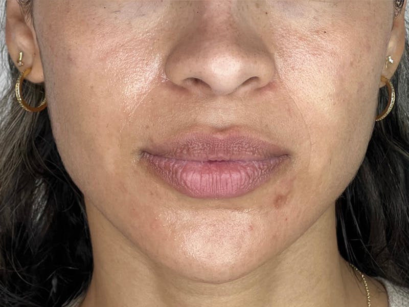 Facial Balancing Before & After Gallery - Patient 339887 - Image 2
