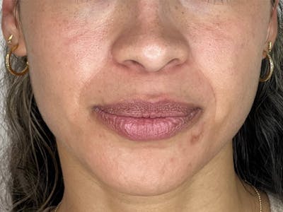 Facial Balancing Before & After Gallery - Patient 339887 - Image 1