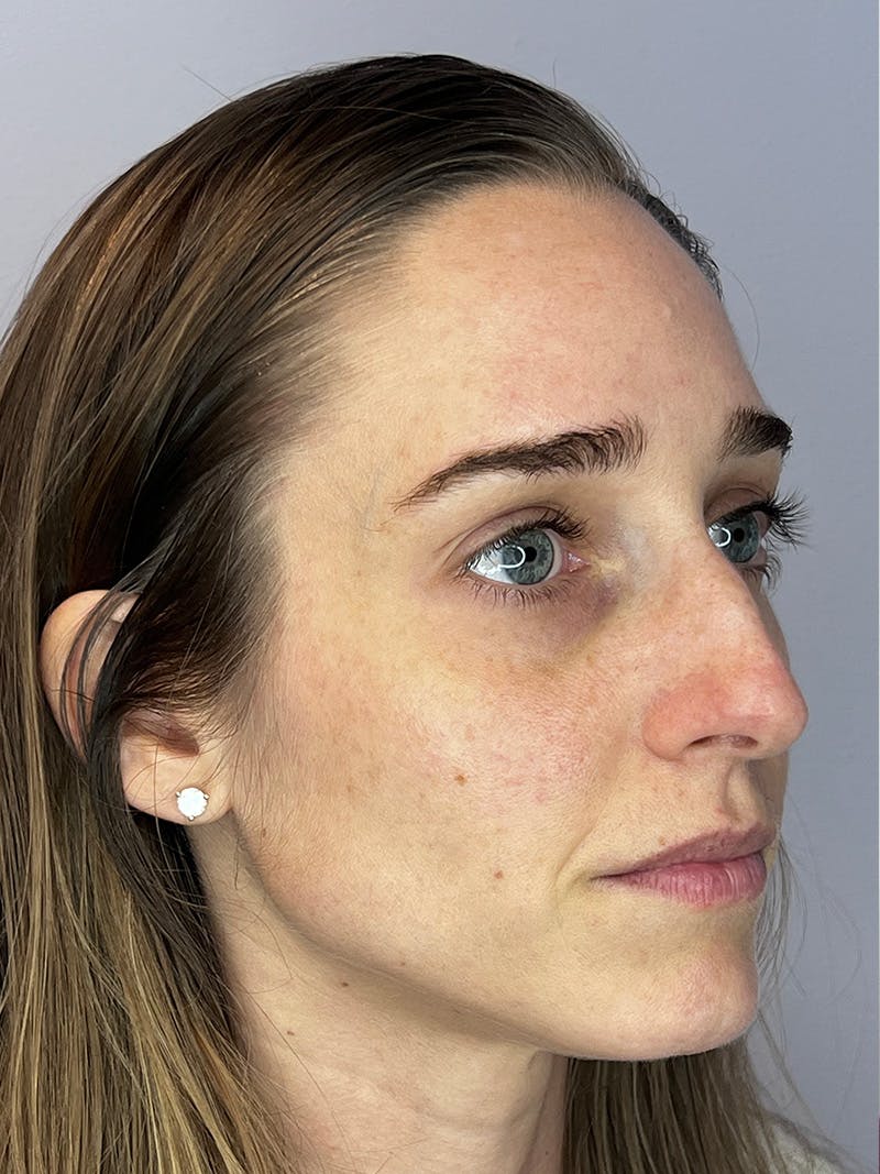 Sculptra Before & After Gallery - Patient 194961 - Image 3