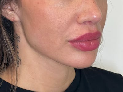 Facial Filler Before & After Gallery - Patient 159130 - Image 2