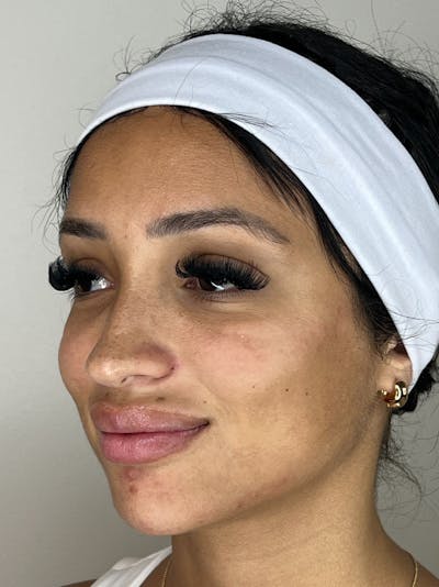 Facial Balancing Before & After Gallery - Patient 122722 - Image 2
