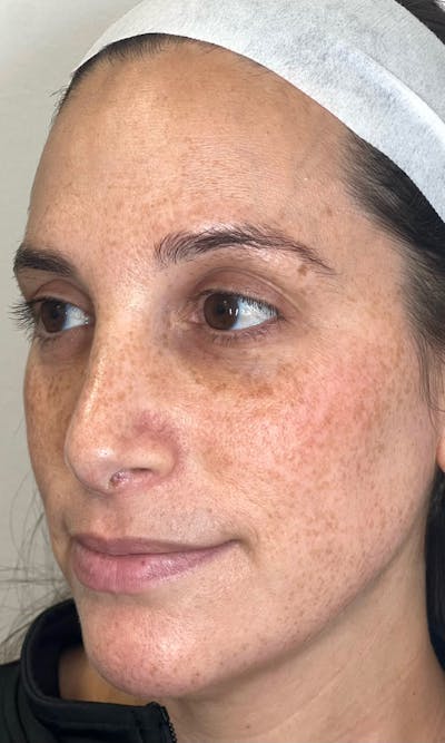 Moxi Laser Before & After Gallery - Patient 551789 - Image 1
