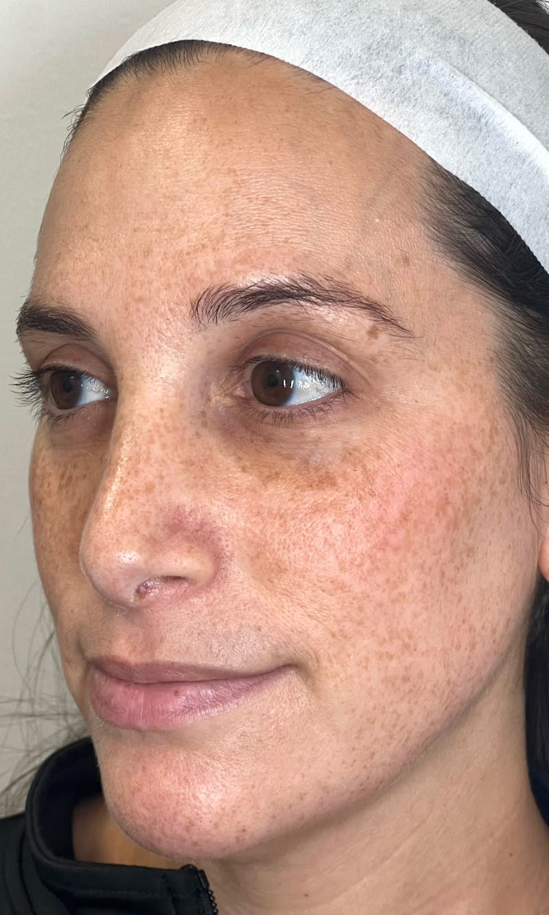 Moxi Laser Before & After Gallery - Patient 551789 - Image 1