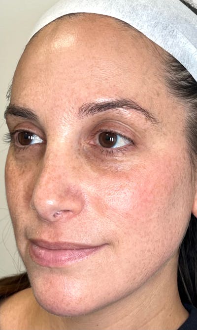 Moxi Laser Before & After Gallery - Patient 551789 - Image 2