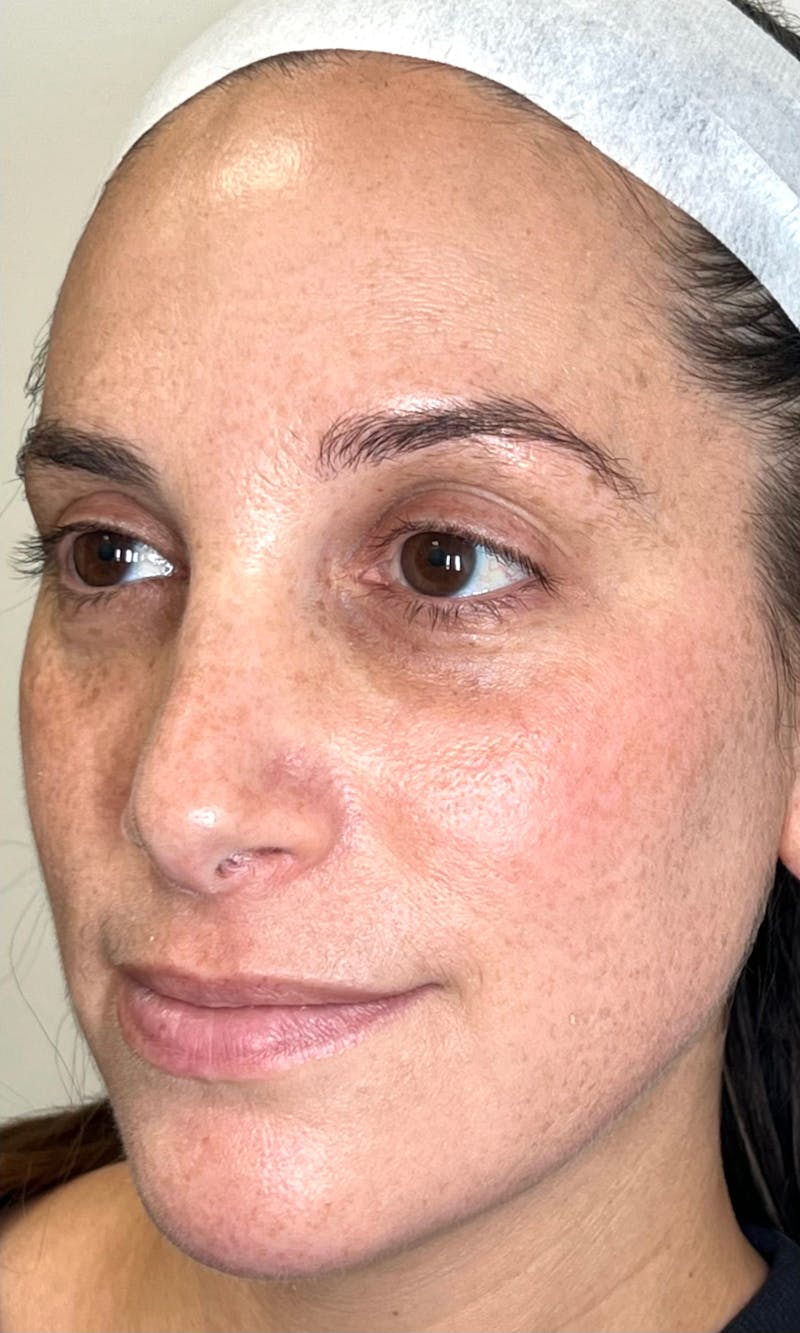 Moxi Laser Before & After Gallery - Patient 551789 - Image 2
