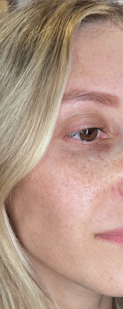 Moxi Laser Before & After Gallery - Patient 259411 - Image 1