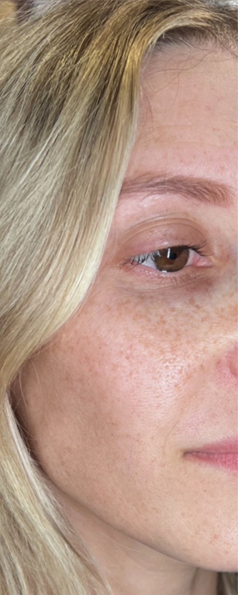 Moxi Laser Before & After Gallery - Patient 259411 - Image 1