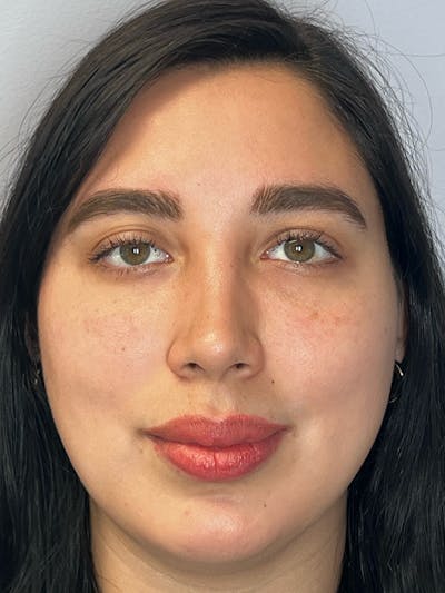 Moxi Laser Before & After Gallery - Patient 210948 - Image 1
