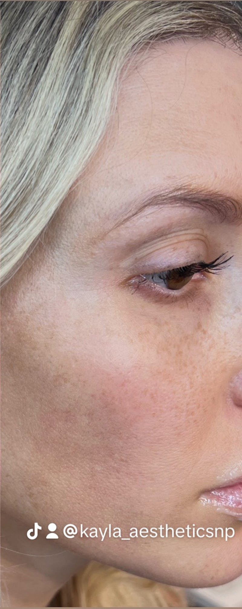 Moxi Laser Before & After Gallery - Patient 259411 - Image 2