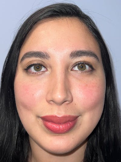 Moxi Laser Before & After Gallery - Patient 210948 - Image 2