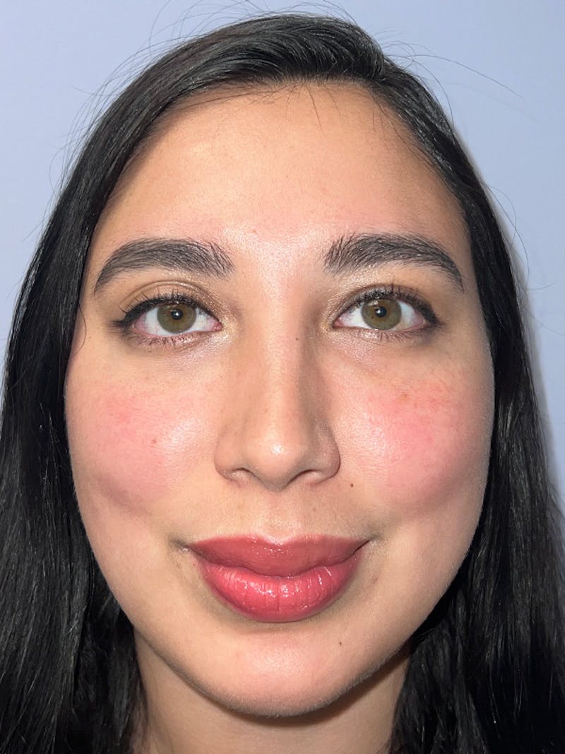Moxi Laser Before & After Gallery - Patient 210948 - Image 2