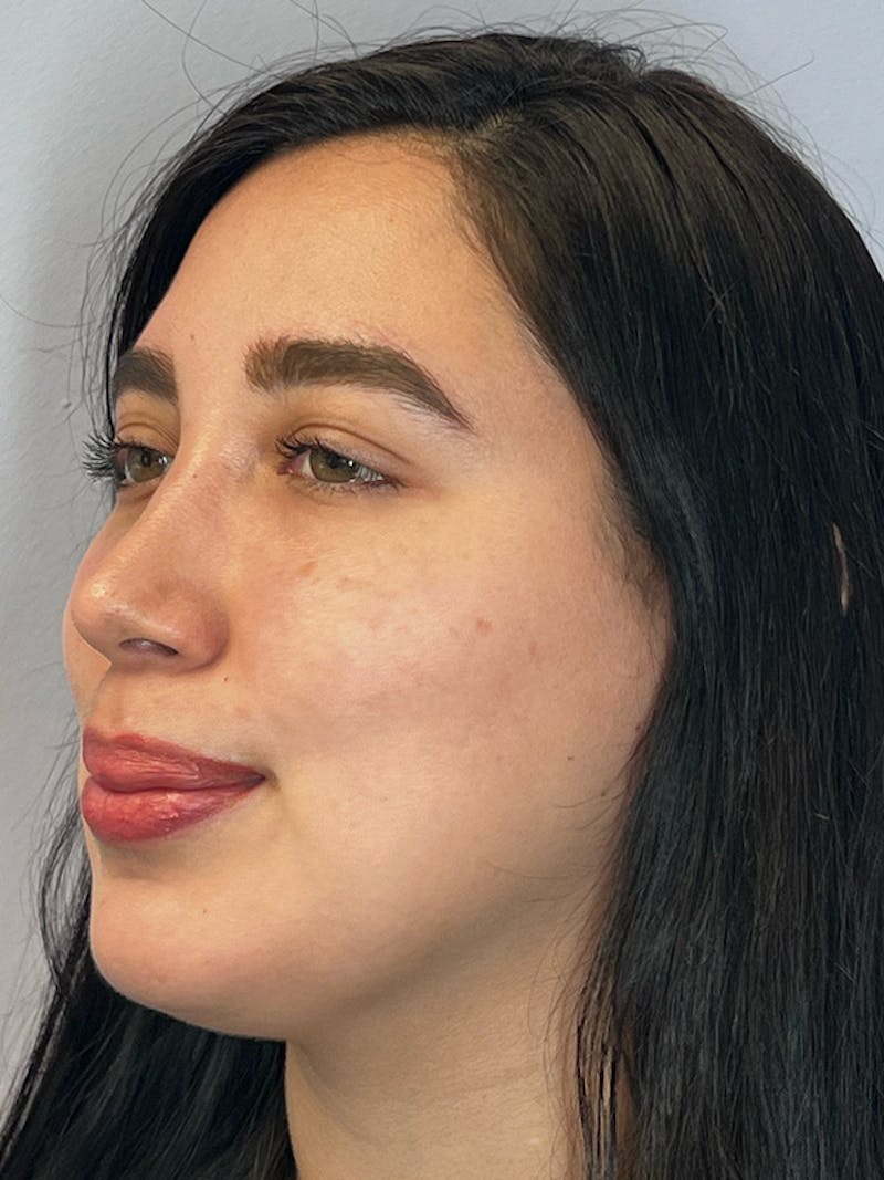 Moxi Laser Before & After Gallery - Patient 210948 - Image 3