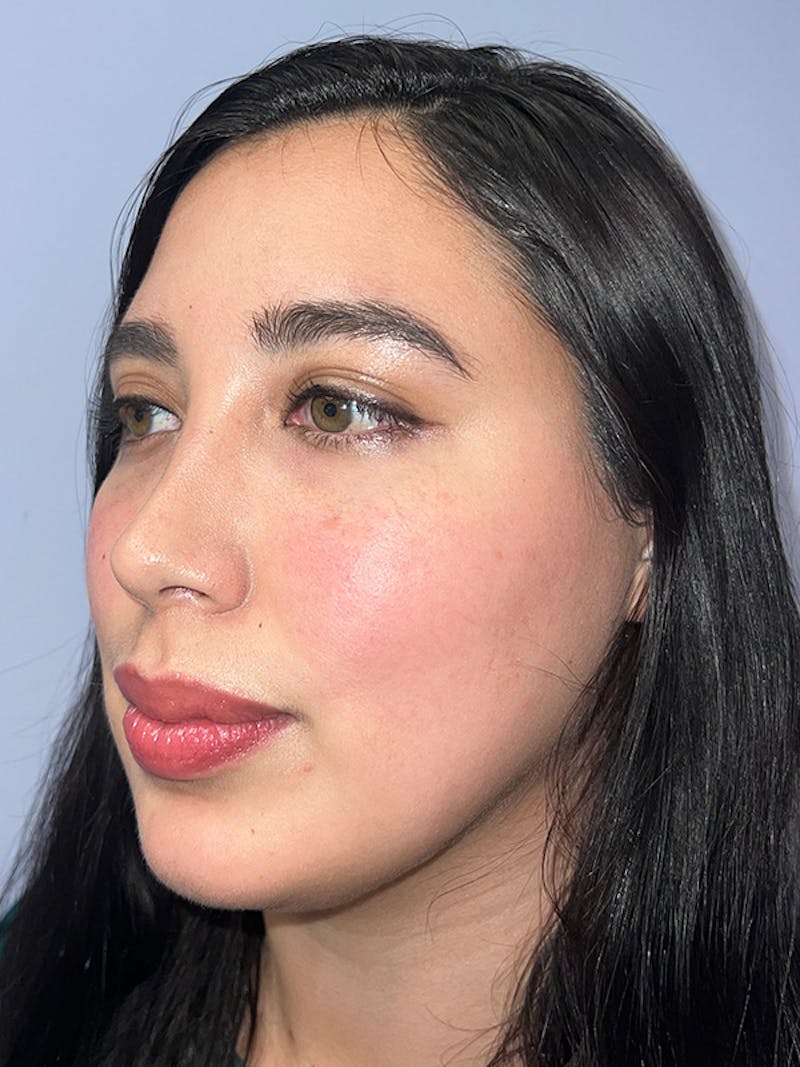 Moxi Laser Before & After Gallery - Patient 210948 - Image 4