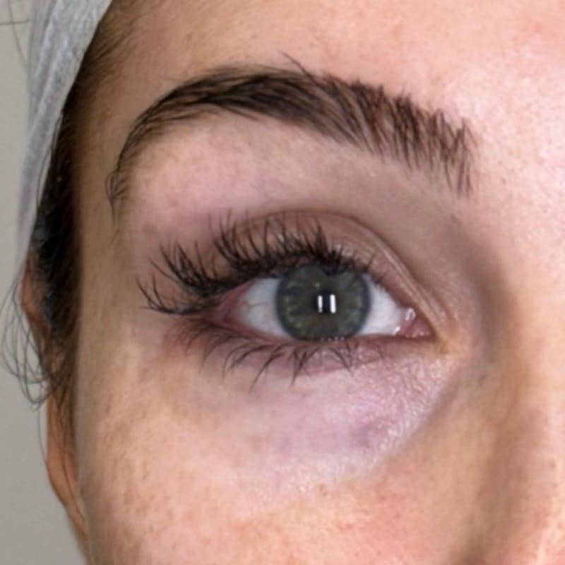 PRF Before & After Gallery - Patient 163960 - Image 1