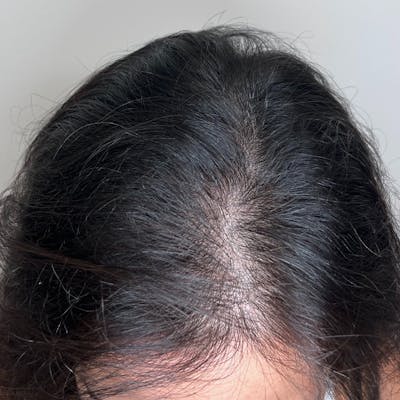 Hair Restoration Before & After Gallery - Patient 333822 - Image 1