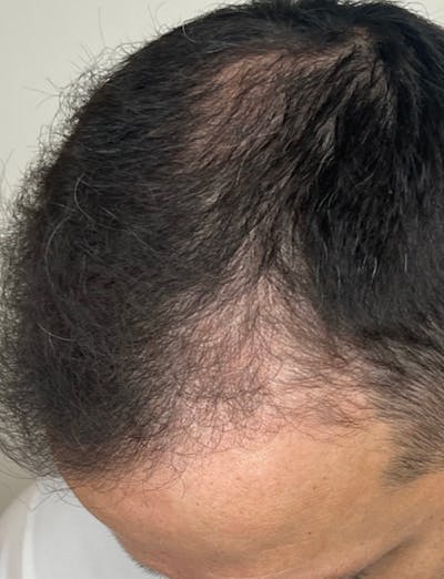 Hair Restoration Before & After Gallery - Patient 299848 - Image 2