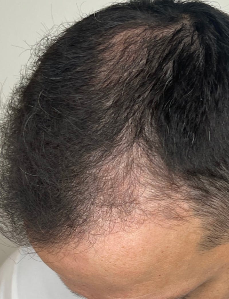PRF Before & After Gallery - Patient 242002 - Image 2