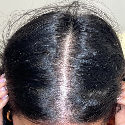 Hair Restoration Before & After Gallery - Patient 333822 - Image 2