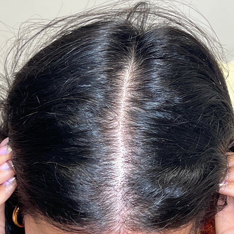 PRF Before & After Gallery - Patient 254442 - Image 2