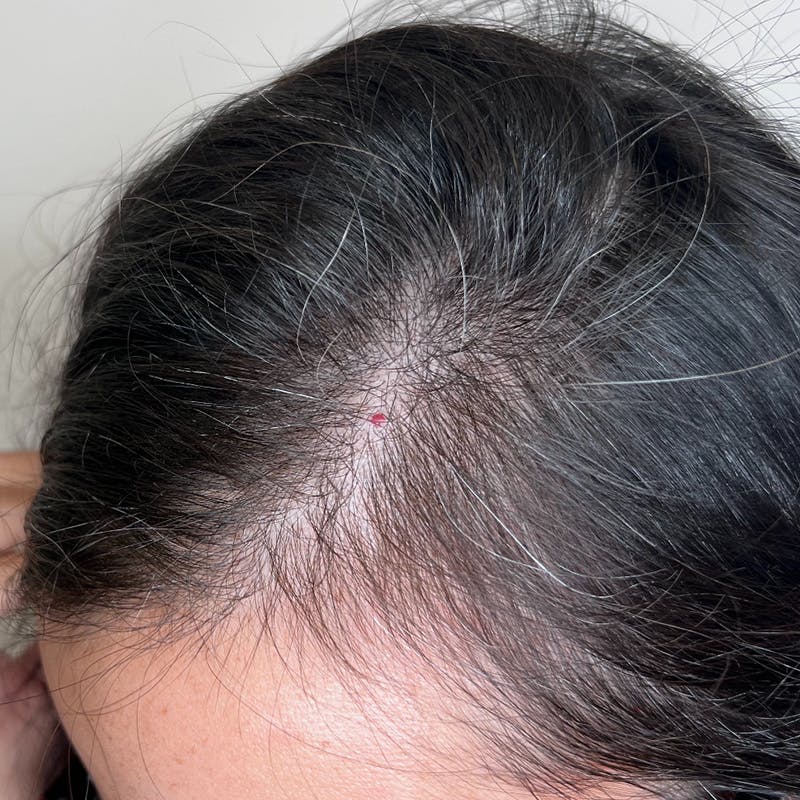 PRF Before & After Gallery - Patient 254442 - Image 5