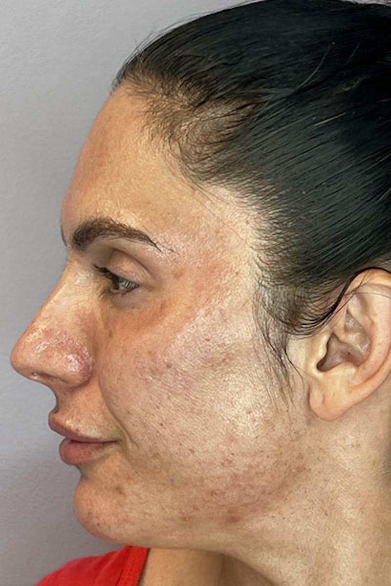 PRF Before & After Gallery - Patient 194614 - Image 5