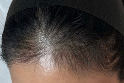 Hair Restoration Before & After Gallery - Patient 273901 - Image 2