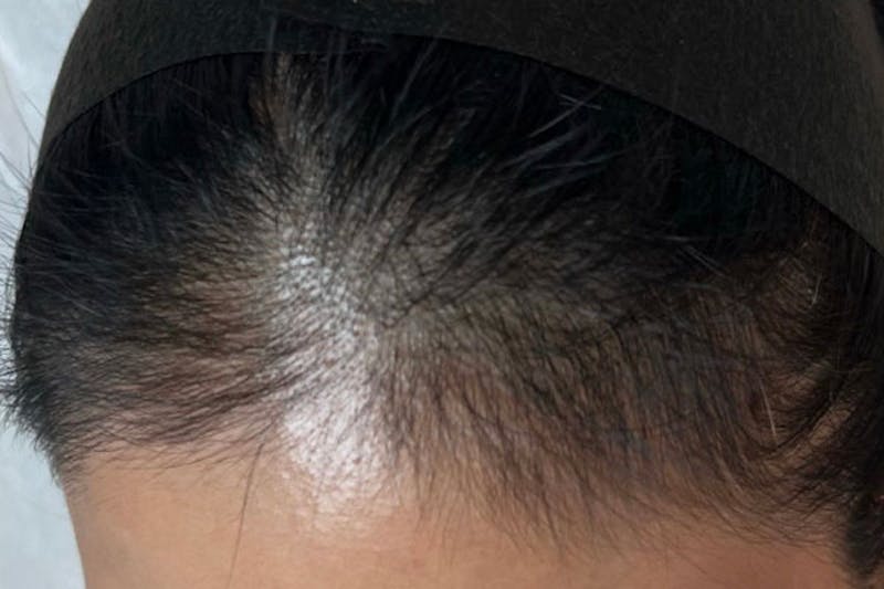 Hair Restoration Before & After Gallery - Patient 273901 - Image 2